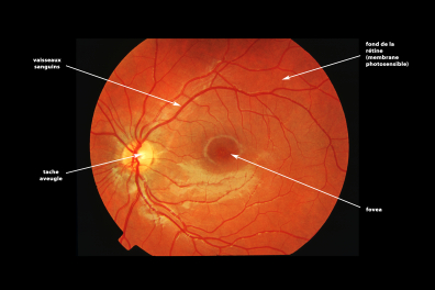 Fond de rétine d'un enfant de 12 ans (vue légendée)